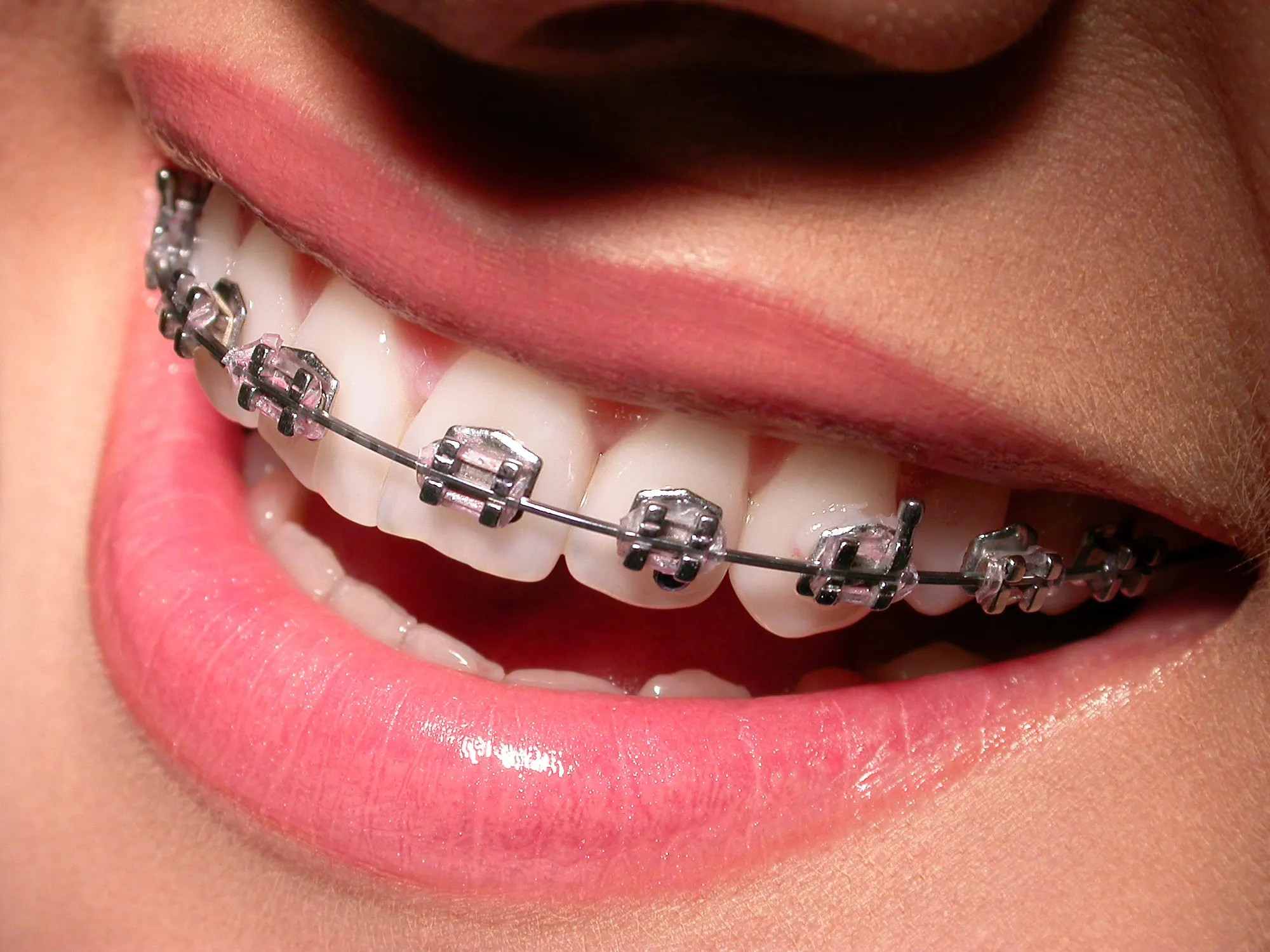 Snus and your gums: what a nicotine pouch really does